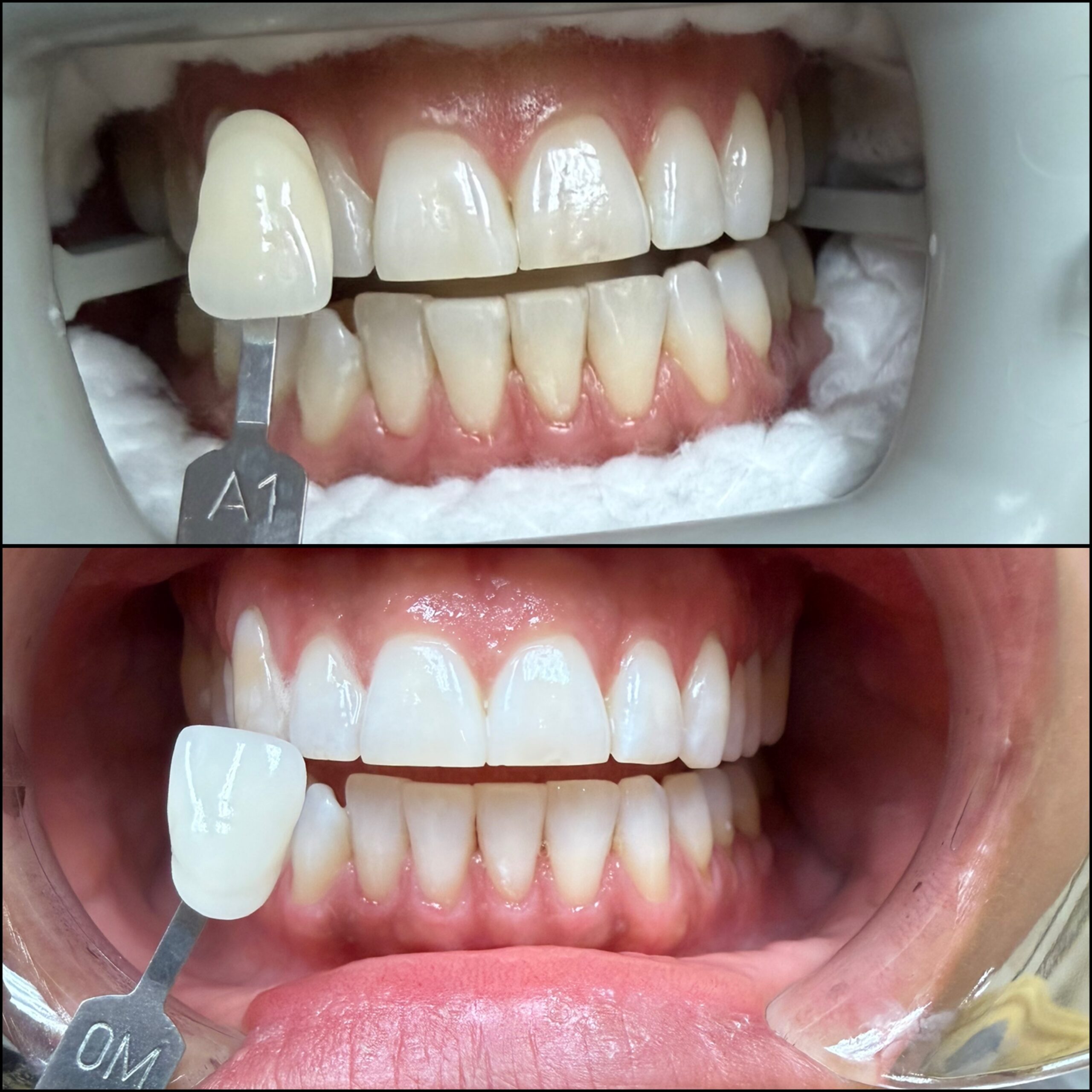 jupiter-dentist-teeth-whitening-results-before-after