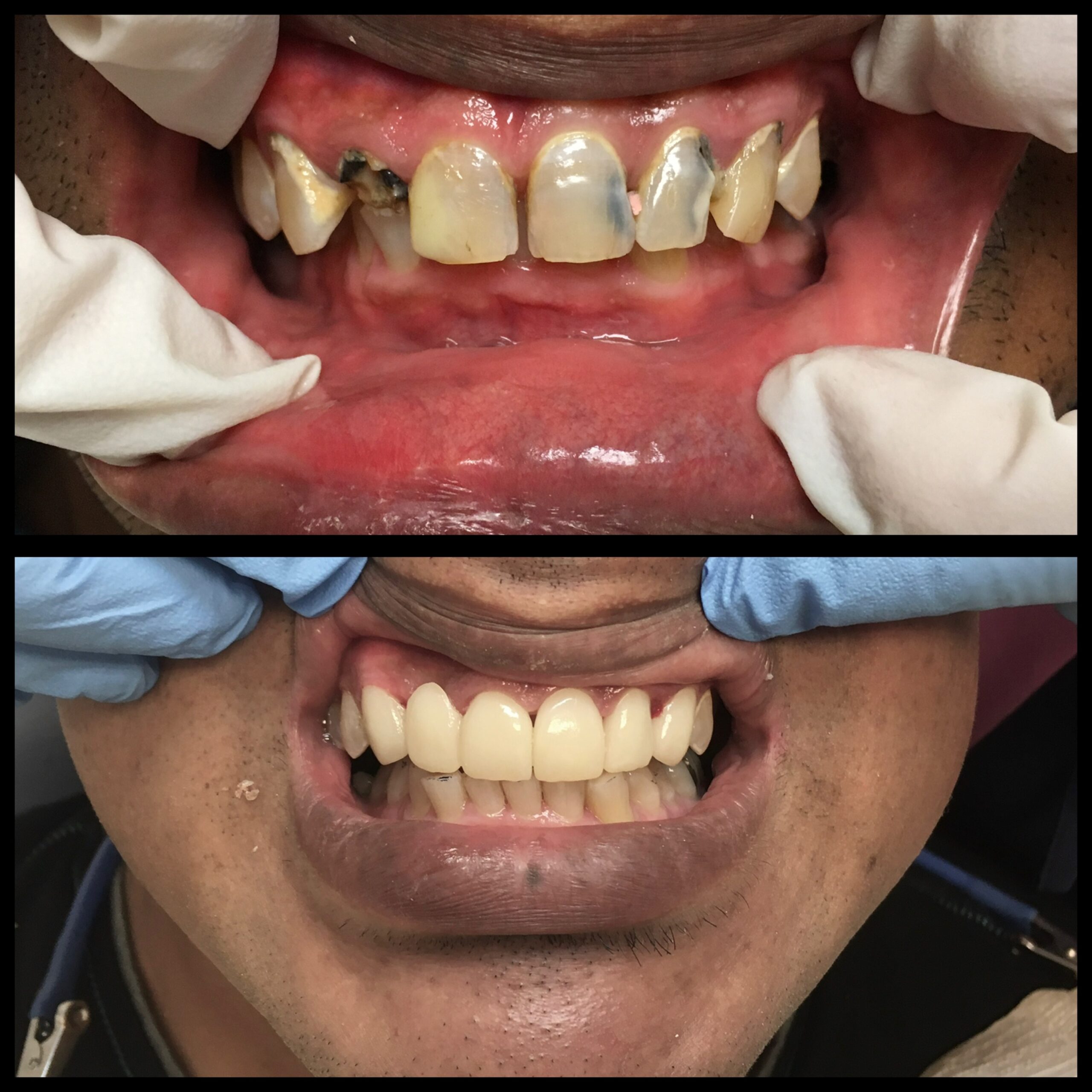 smile-makeover-jupiter-fl-before-after