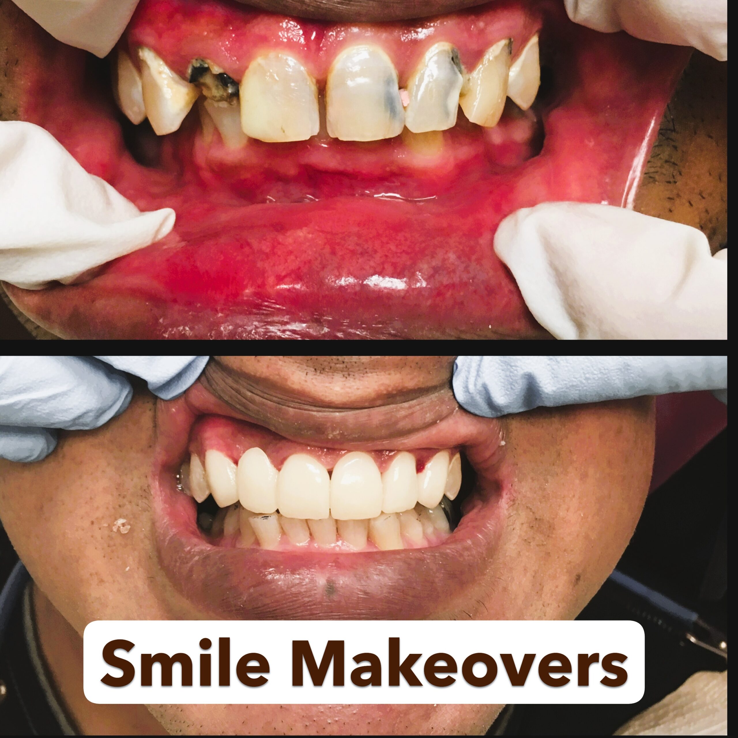 smile-makeover-jupiter-fl-before-after2