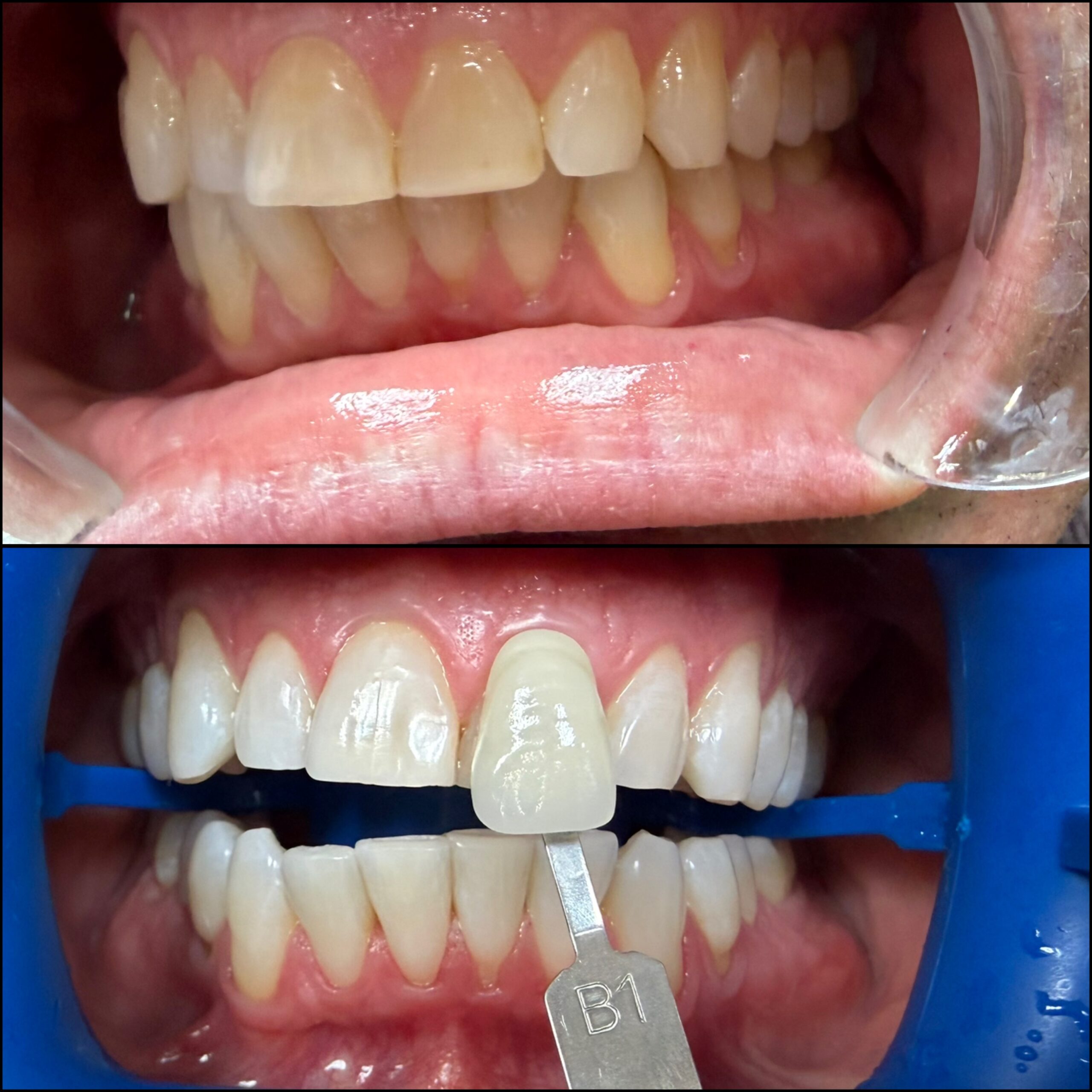 zoom-teeth-whitening-jupiter-fl-before-aft